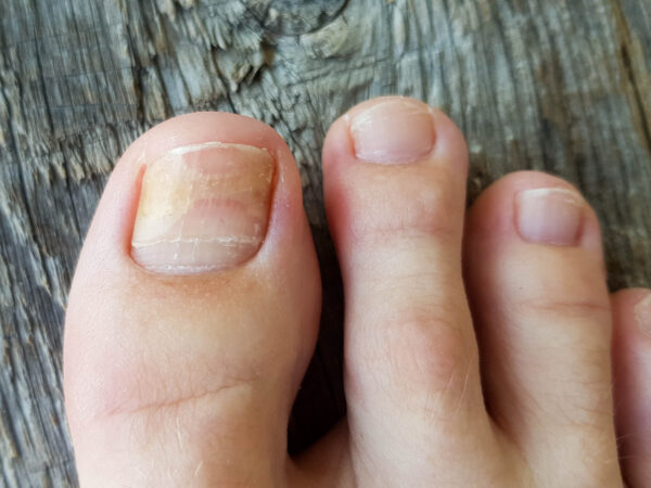 Choroby paznokci – objawy, rodzaje i diagnostyka