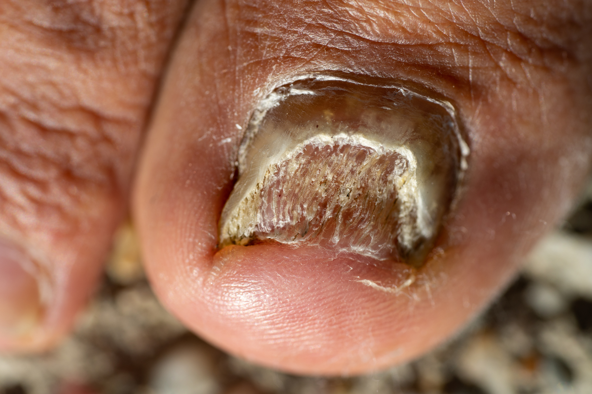 Na tym obrazku widzimy zbliżenie na stopę, na której widoczna jest choroba paznokci. Paznokieć jest dotknięty nieprawidłowościami, które wskazują na obecność schorzenia.Paznokieć jest zdeformowany i ma różne nieprawidłowości. Może być pogrubiony, skorodowany, łamliwy, rozwarstwiony lub zmienić kolor. Te zmiany wskazują na możliwość występowania grzybicy paznokci, infekcji lub innego schorzenia paznokciowego